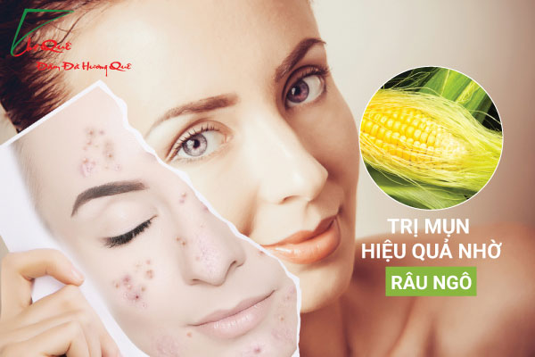 TRỊ MỤN HIỆU QUẢ NHỜ RÂU NGÔ